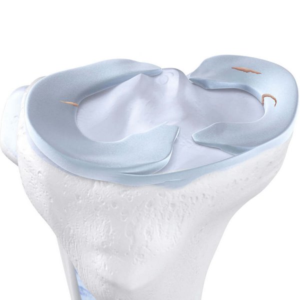 Darstellung der Anatomie des Knies bei einem Meniskusriss. 